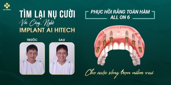Bảng giá trồng răng Implant toàn hàm