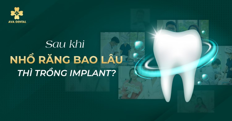 Sau khi nhổ răng bao lâu thì Trồng Implant