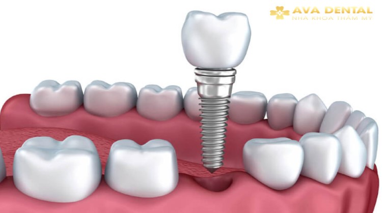 Trồng răng Implant Sau khi nhổ