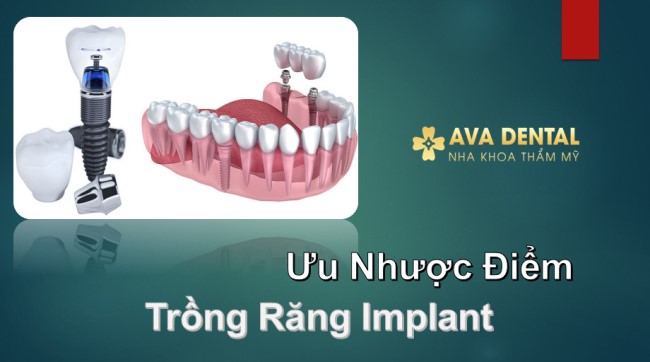 Ưu nhược điểm của Trồng răng Implant