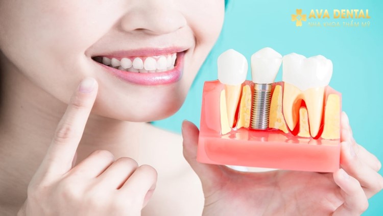 Ưu và nhược điểm của trồng răng implant