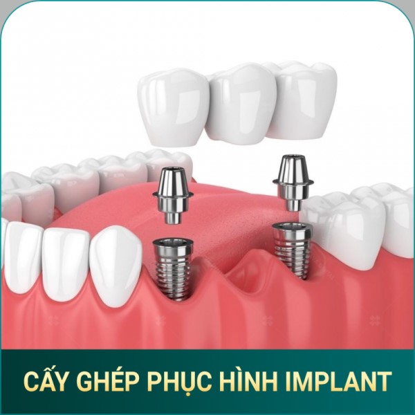 phuc hinh implant AVA Dental