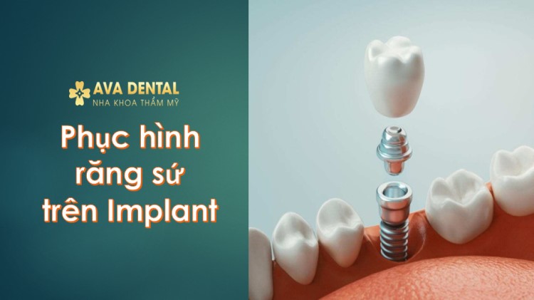 phục hình răng sứ trên Implant