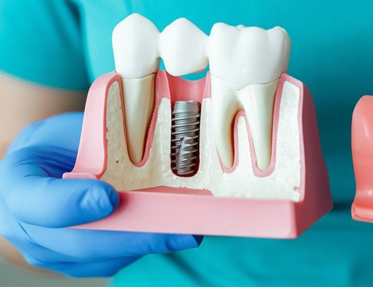 Trồng răng Implant thời gian bao lâu?
