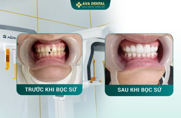 Cách Chăm Sóc Răng Sau Khi Bọc Răng Sứ