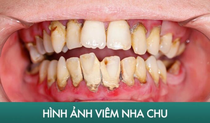 Giải Đáp Thắc Mắc Viêm Nha Chu Là Gì