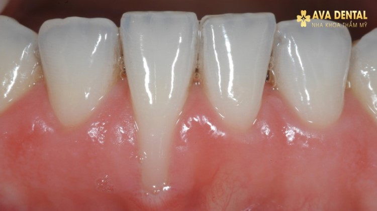 Tụt lợi chân răng Triệu chứng, nguyên nhân và cách khắc phục