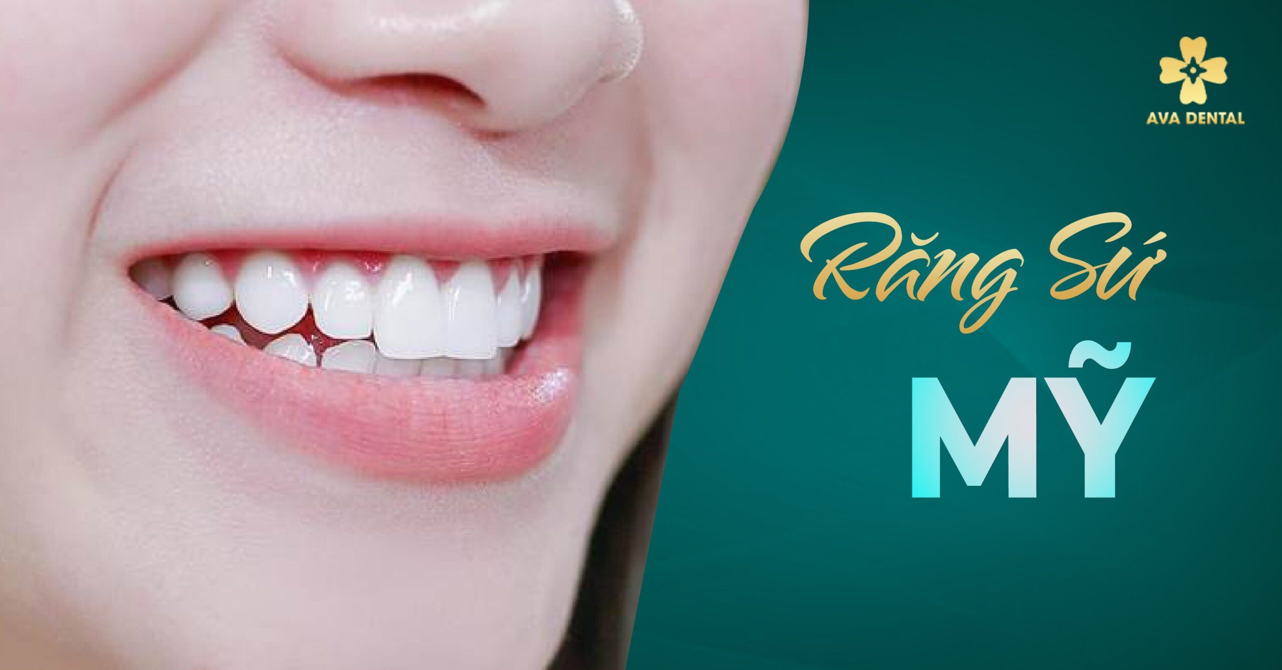 răng sứ Mỹ