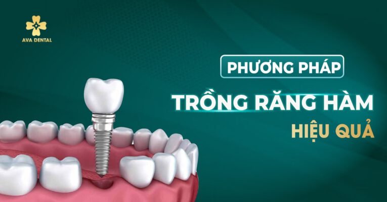 phương pháp trồng răng hàm hiệu quả