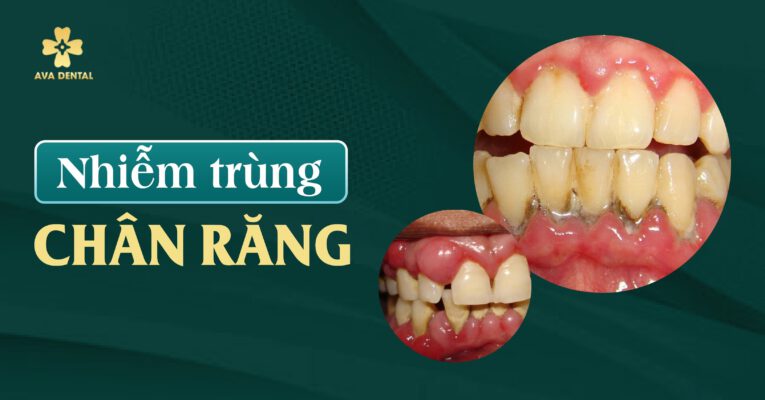 nhiễm trùng chân răng