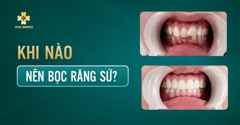 khi nào nên bọc răng sứ