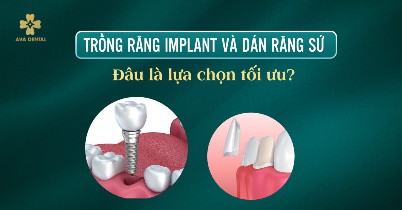 Trồng răng Implant và dán răng sứ