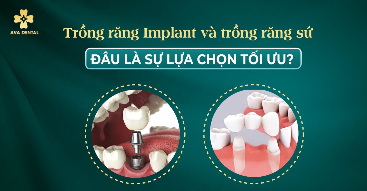 Trồng răng Implant và trồng răng sứ