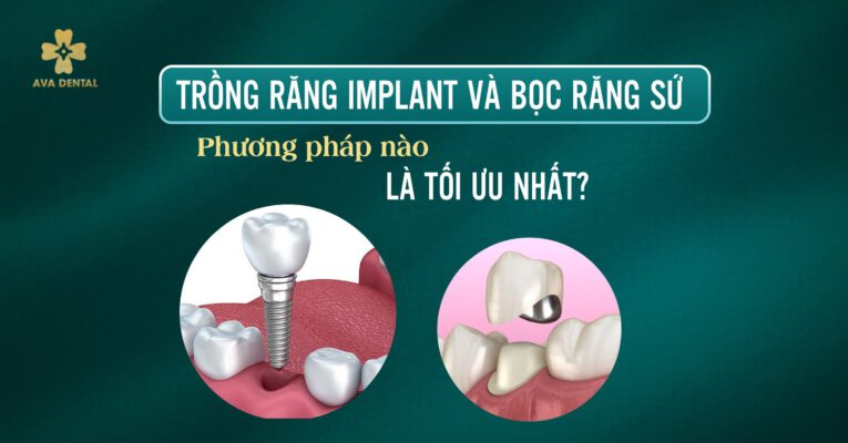 trồng răng Implant và bọc răng sứ