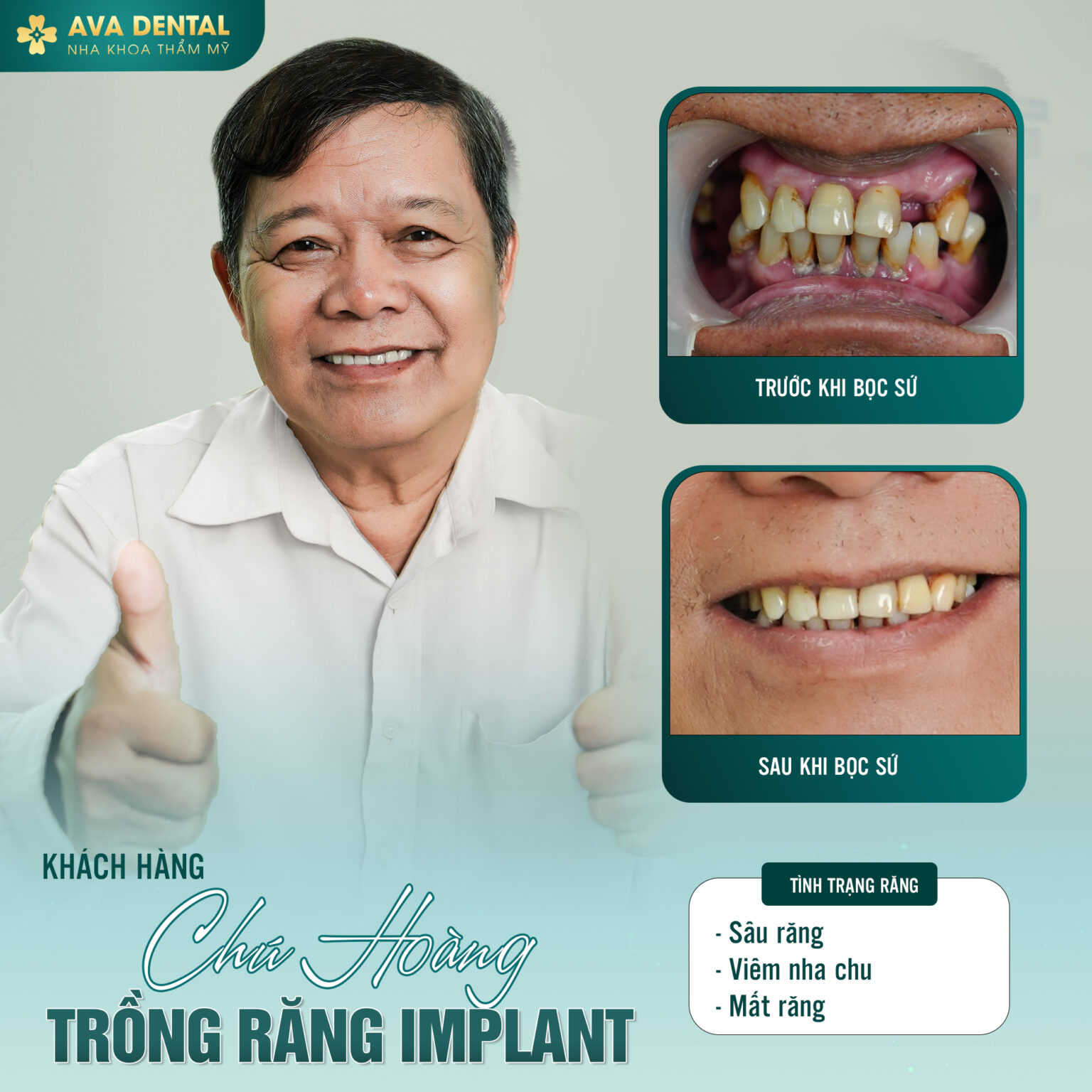 Bật Mí Thông Tin Hữu Ích Về Trồng Răng Implant - AVA Dental