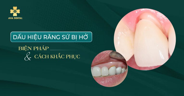 Dấu hiệu răng sứ bị hở