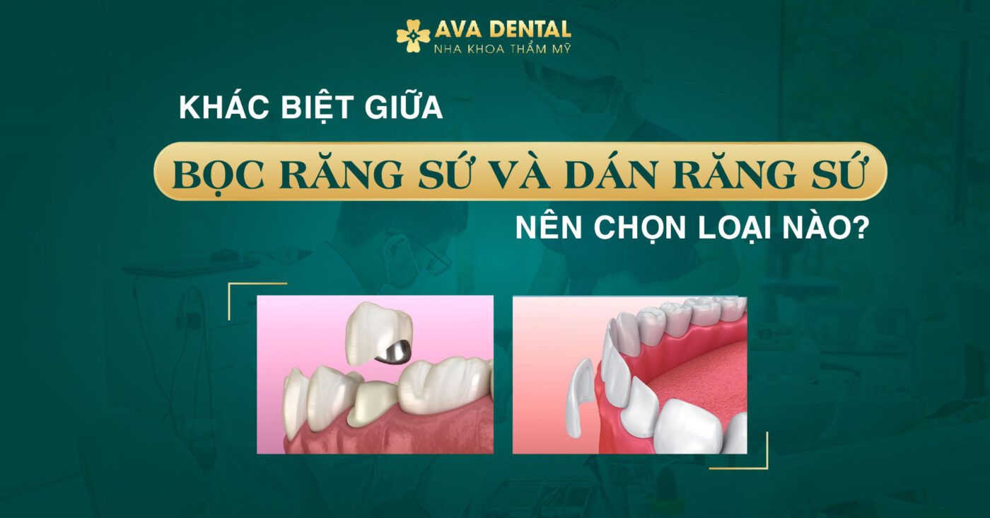 So sánh hai phương pháp trồng răng Bọc răng sứ và Dán răng sứ