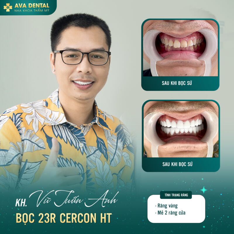 Răng sứ CERCON HT là một loại răng sứ cao cấp được sản xuất tại Đức.
