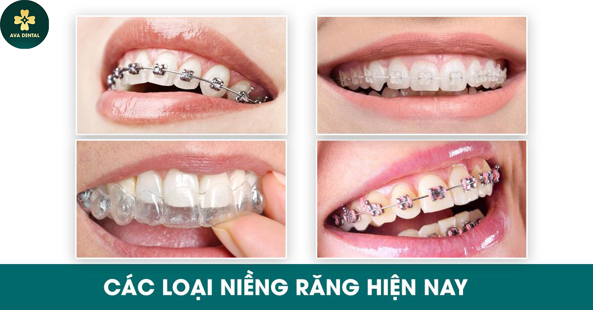 Giá niềng răng tại AVA Dental