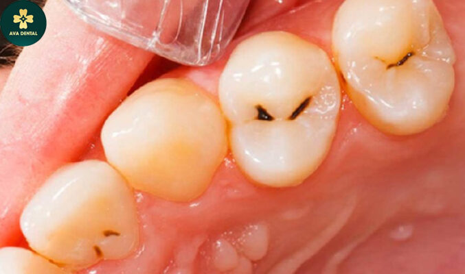 viêm tủy răng là gì?