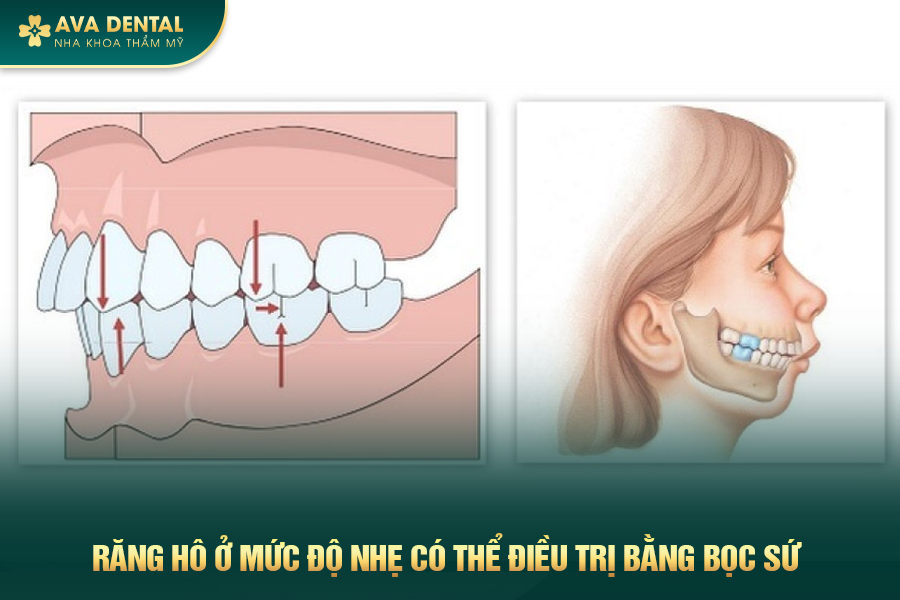 boc rang su cho rang ho 1