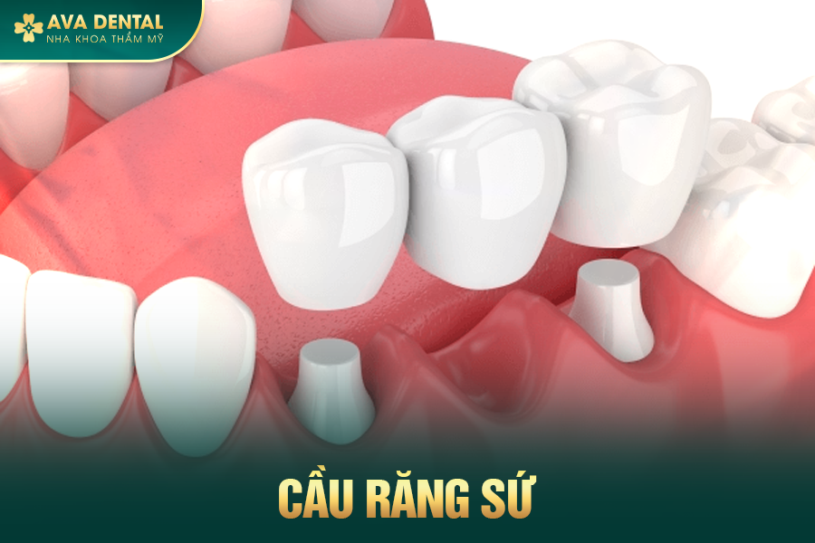 cau rang su 1