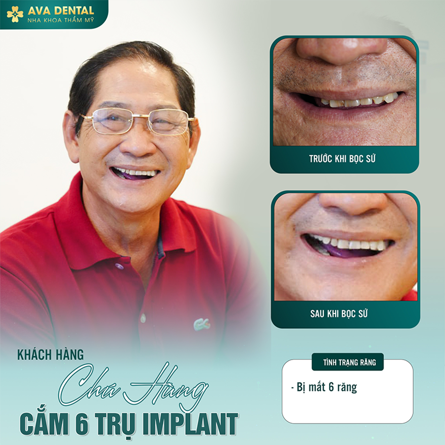 implant 3