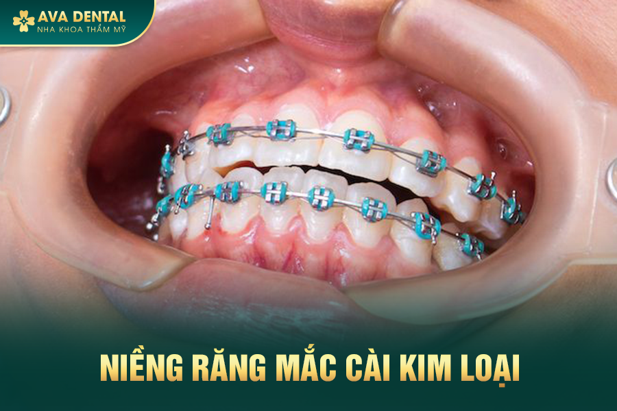 nieng mac cai kim loai 1